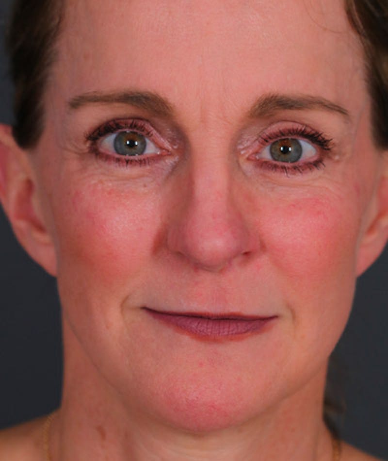 Facelift Before & After Gallery - Patient 108404346 - Image 6
