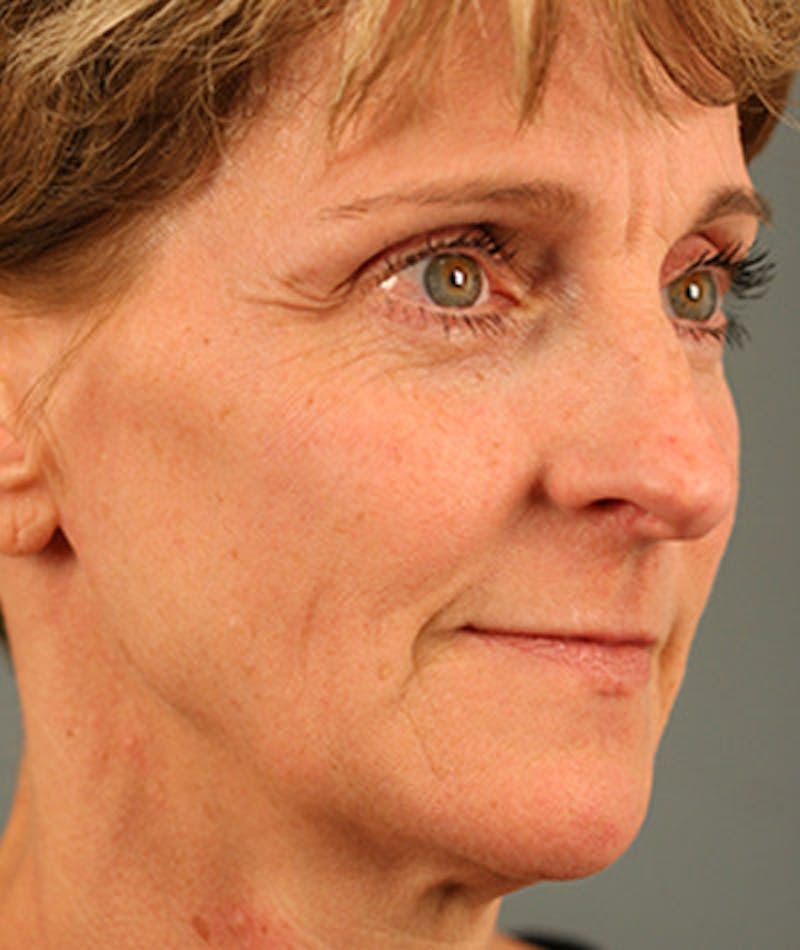 Facelift Before & After Gallery - Patient 108404346 - Image 1