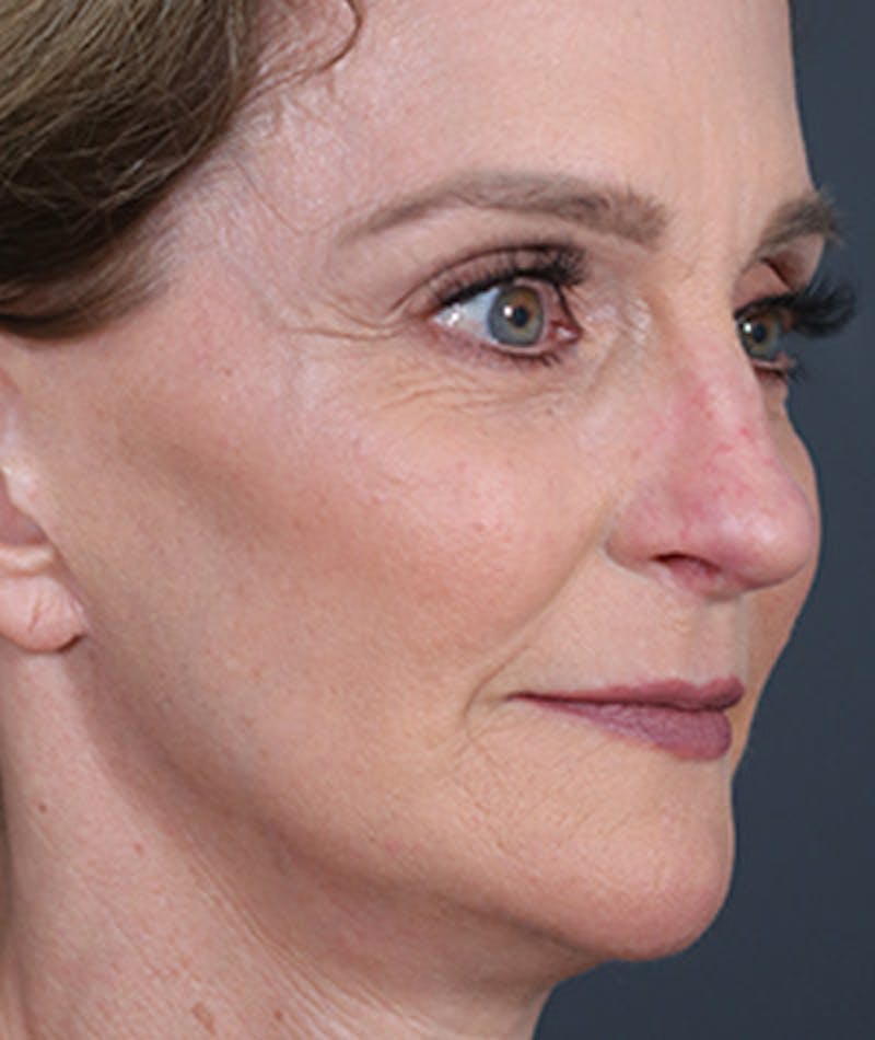 Facelift Before & After Gallery - Patient 108404346 - Image 2