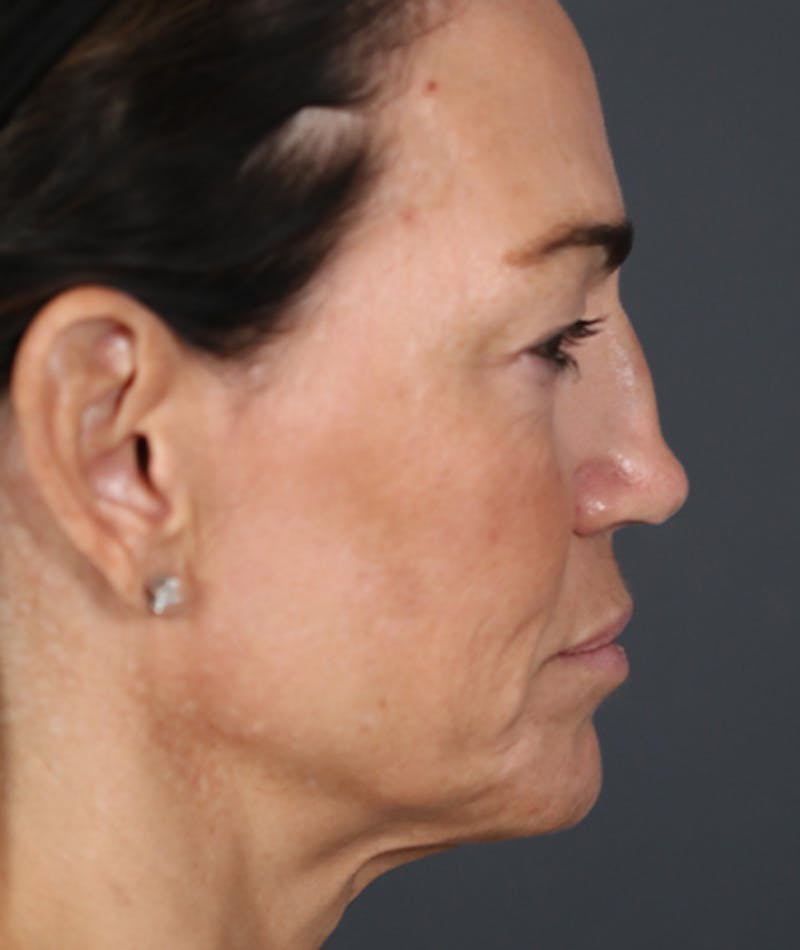 Facelift Before & After Gallery - Patient 108404385 - Image 3