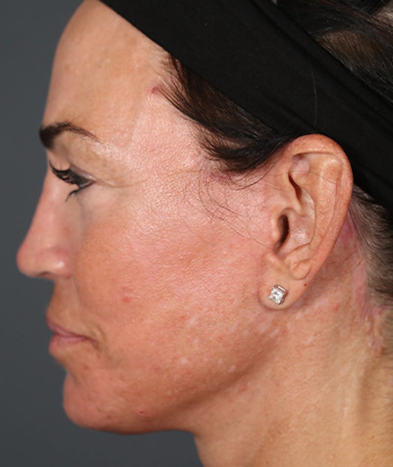 Facelift Before & After Gallery - Patient 108404385 - Image 4