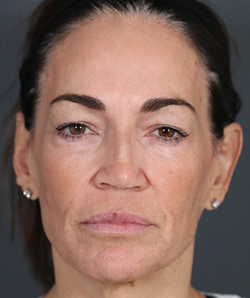 Facelift Before & After Gallery - Patient 108404385 - Image 1