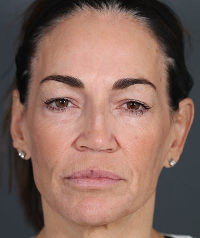 Facelift Before & After Gallery - Patient 108404385 - Image 1