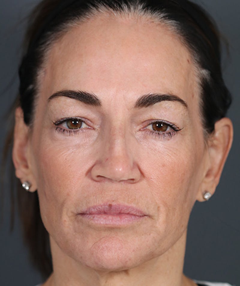 Facelift Before & After Gallery - Patient 108404385 - Image 1