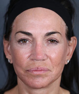 Facelift Before & After Gallery - Patient 108404385 - Image 2
