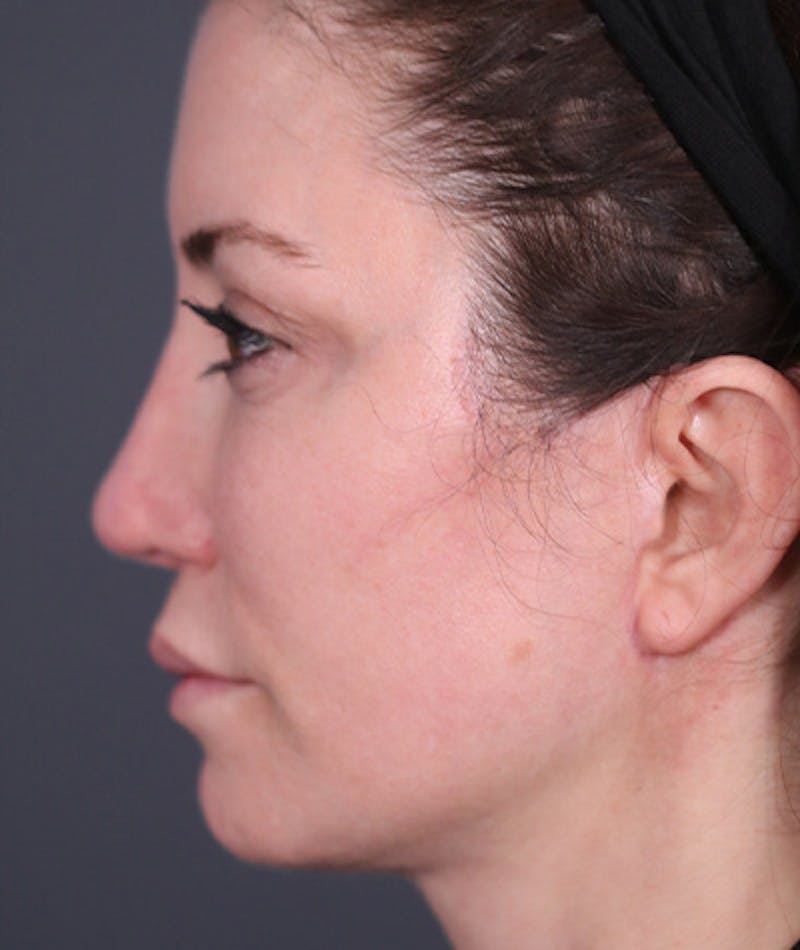Facelift Before & After Gallery - Patient 108404483 - Image 2