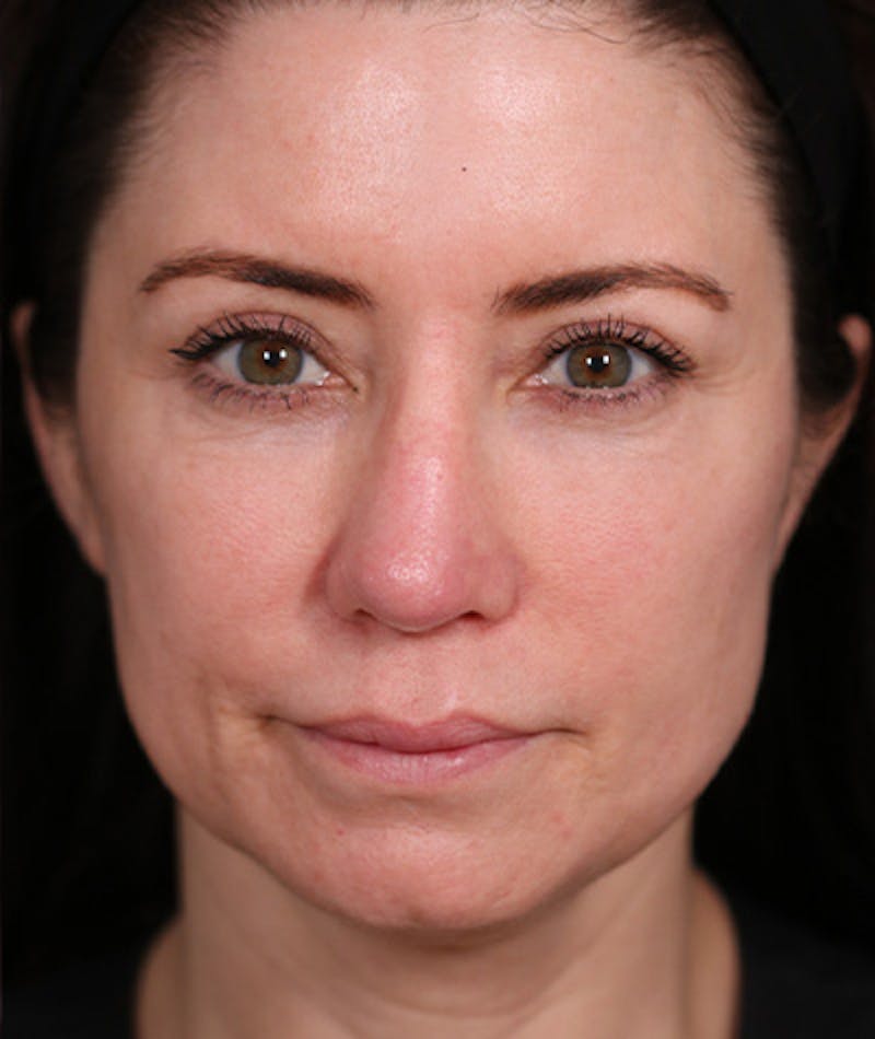 Facelift Before & After Gallery - Patient 108404483 - Image 4