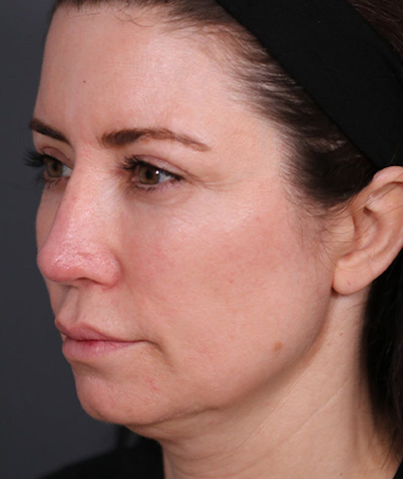 Facelift Before & After Gallery - Patient 108404483 - Image 5