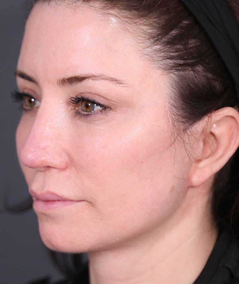 Facelift Before & After Gallery - Patient 108404483 - Image 6