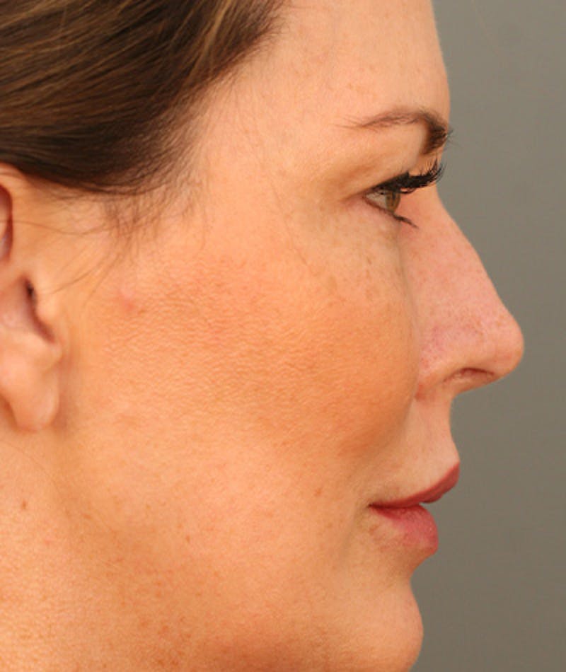 Facelift Before & After Gallery - Patient 108404598 - Image 3