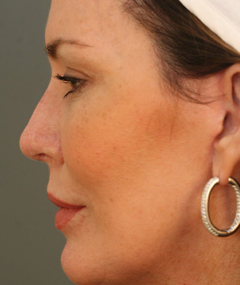 Facelift Before & After Gallery - Patient 108404598 - Image 2