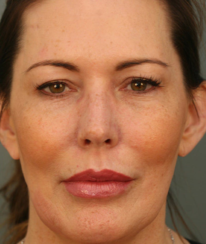 Facelift Before & After Gallery - Patient 108404598 - Image 5
