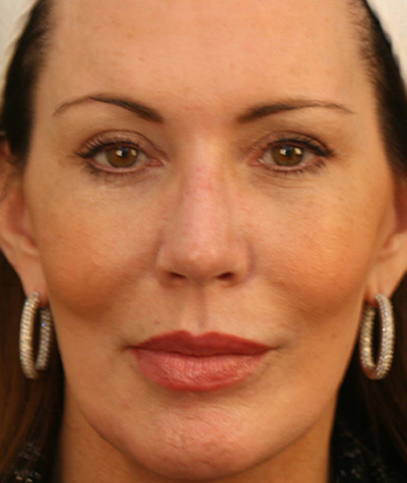Facelift Before & After Gallery - Patient 108404598 - Image 6