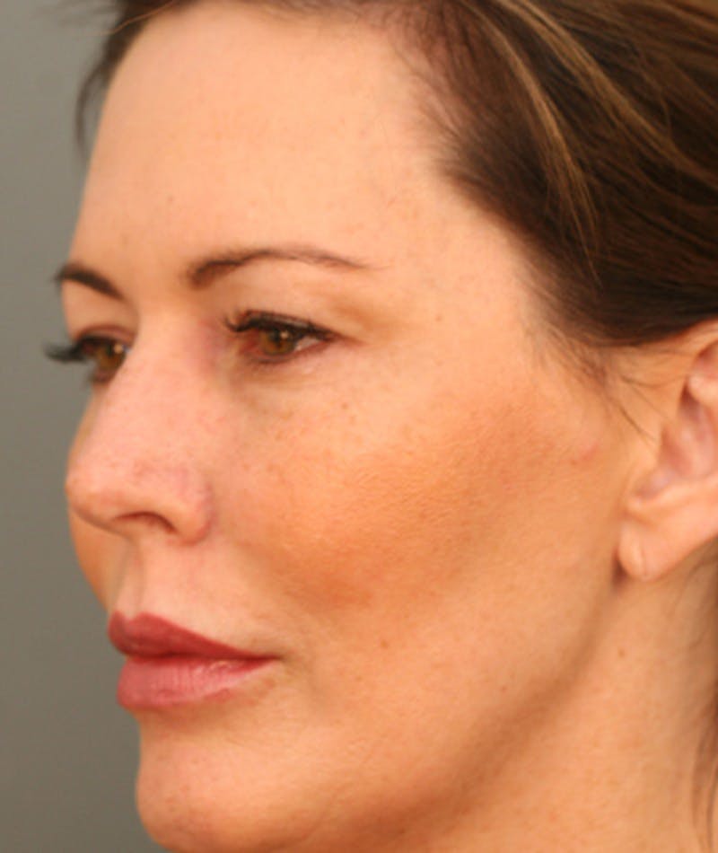 Facelift Before & After Gallery - Patient 108404598 - Image 5