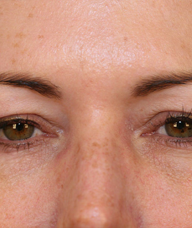 Facelift Before & After Gallery - Patient 108404598 - Image 7