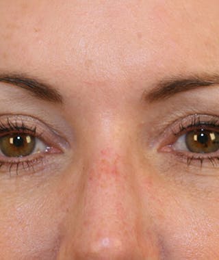 Facelift Before & After Gallery - Patient 108404598 - Image 8