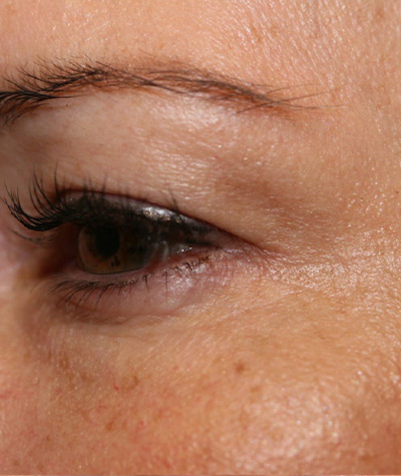 Facelift Before & After Gallery - Patient 108404598 - Image 9
