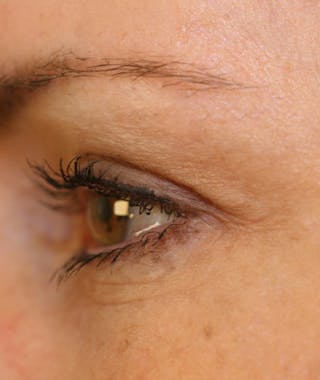 Facelift Before & After Gallery - Patient 108404598 - Image 10