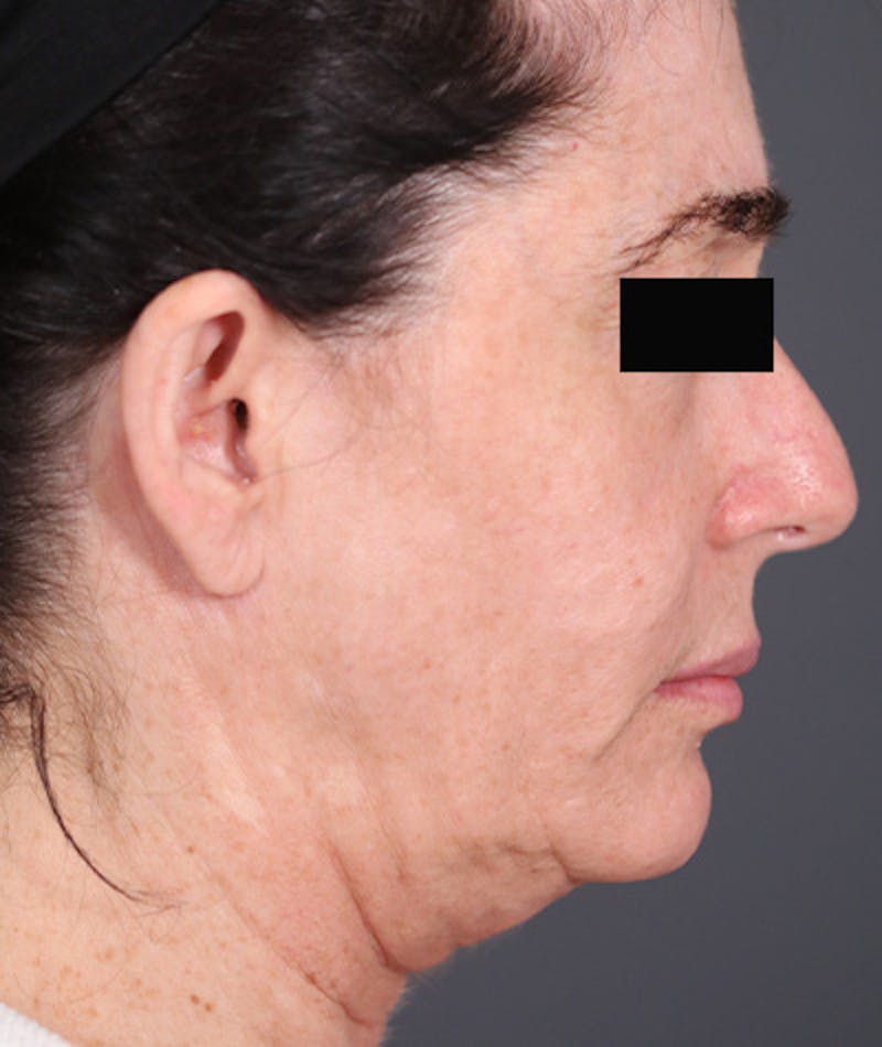 Facelift Before & After Gallery - Patient 108404678 - Image 3