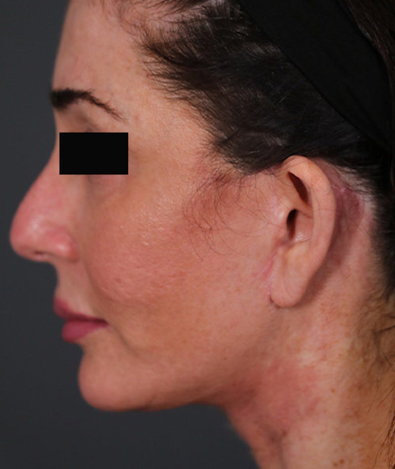 Facelift Before & After Gallery - Patient 108404678 - Image 2