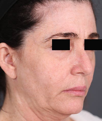 Facelift Before & After Gallery - Patient 108404678 - Image 1