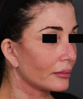 Facelift Before & After Gallery - Patient 108404678 - Image 2