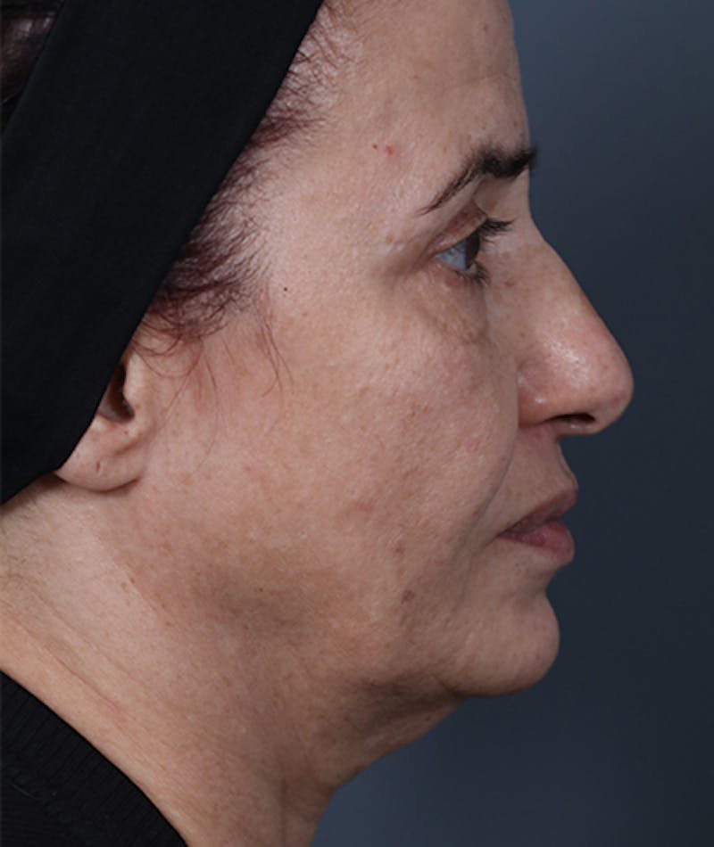 Facelift Before & After Gallery - Patient 108404881 - Image 1