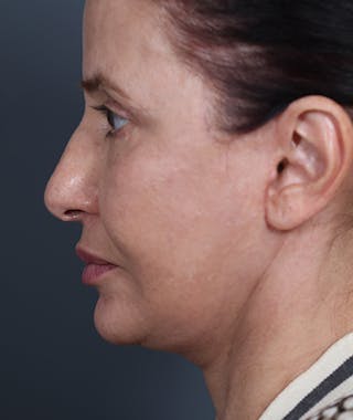 Facelift Before & After Gallery - Patient 108404881 - Image 4
