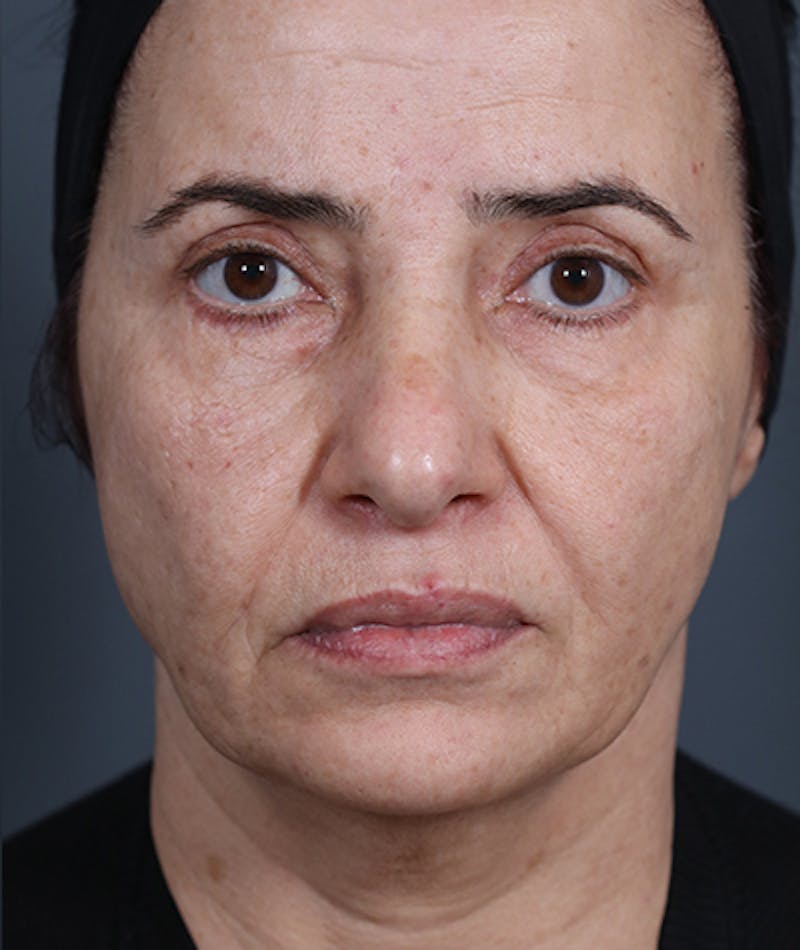Facelift Before & After Gallery - Patient 108404881 - Image 5