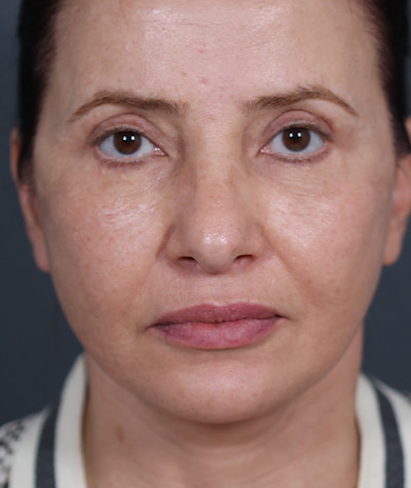 Facelift Before & After Gallery - Patient 108404881 - Image 4