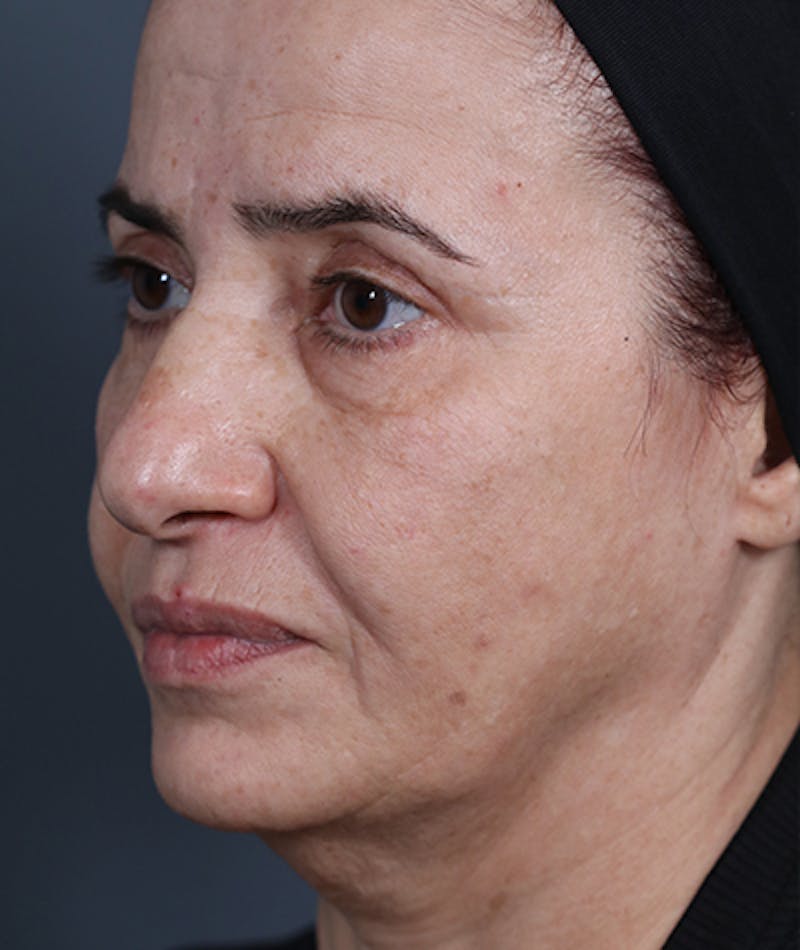 Facelift Before & After Gallery - Patient 108404881 - Image 7