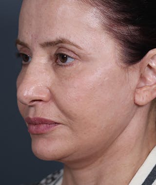 Facelift Before & After Gallery - Patient 108404881 - Image 8