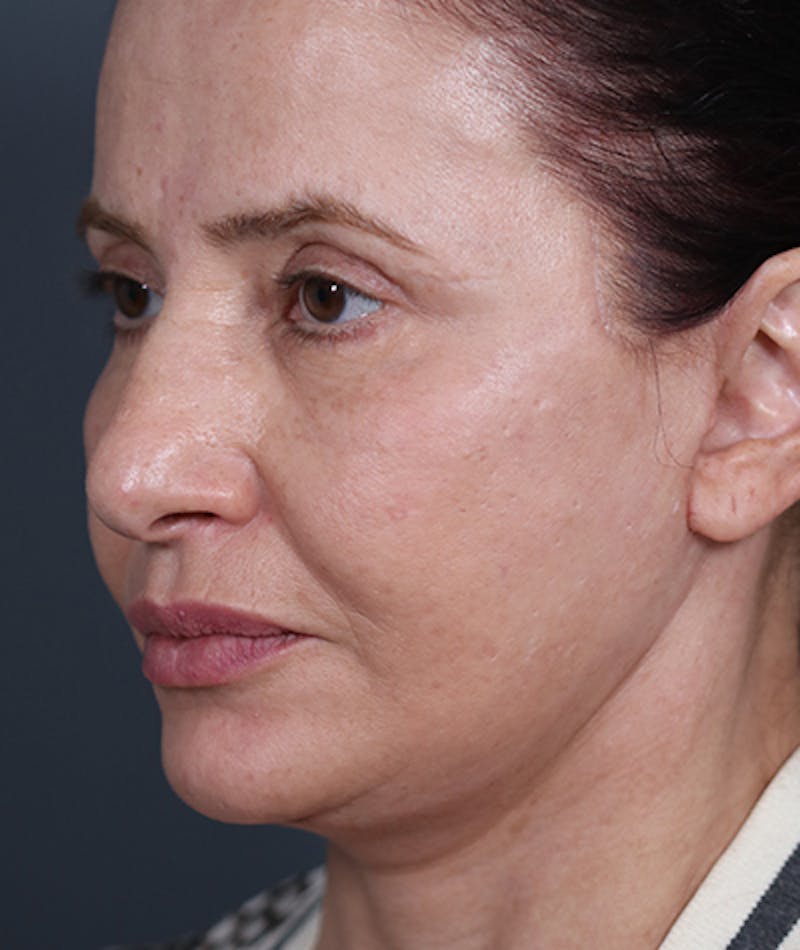 Facelift Before & After Gallery - Patient 108404881 - Image 8