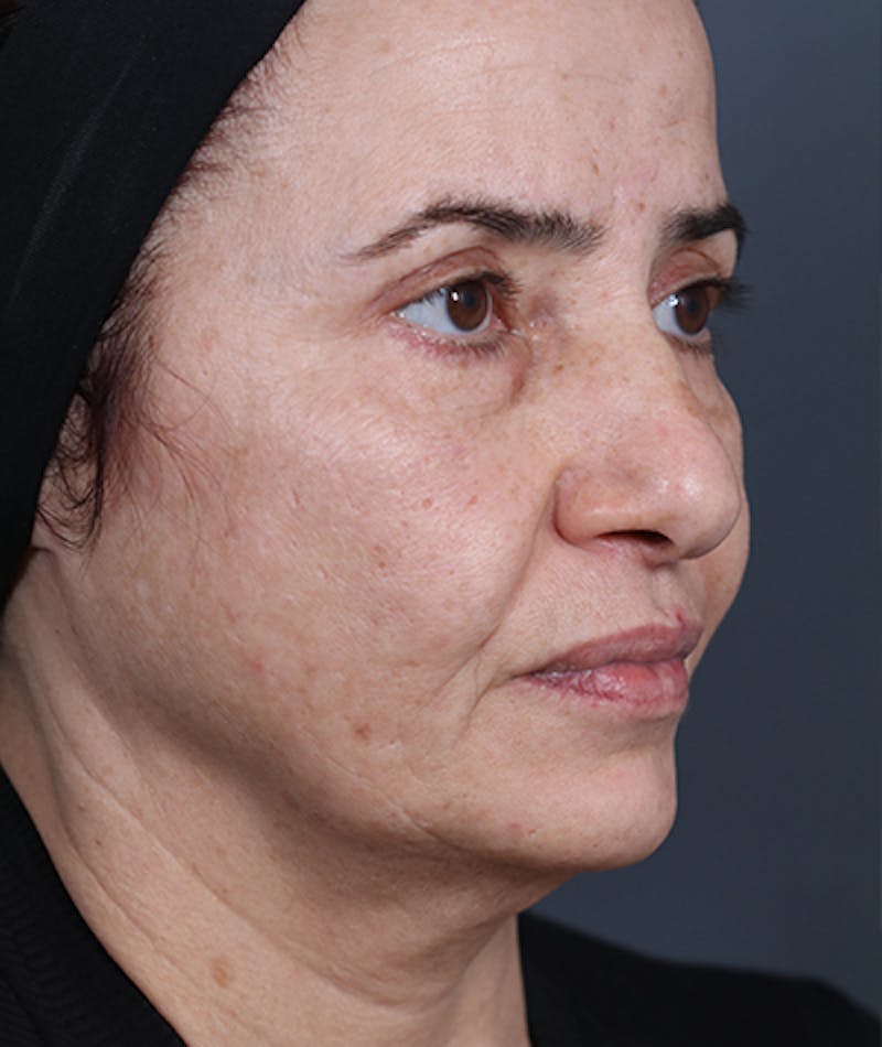 Facelift Before & After Gallery - Patient 108404881 - Image 1