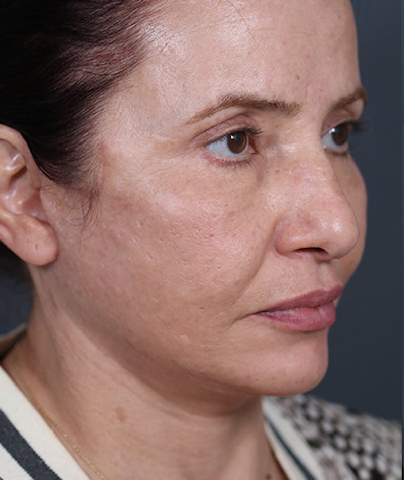 Facelift Before & After Gallery - Patient 108404881 - Image 2