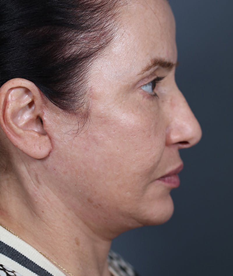 Facelift Before & After Gallery - Patient 108404881 - Image 9