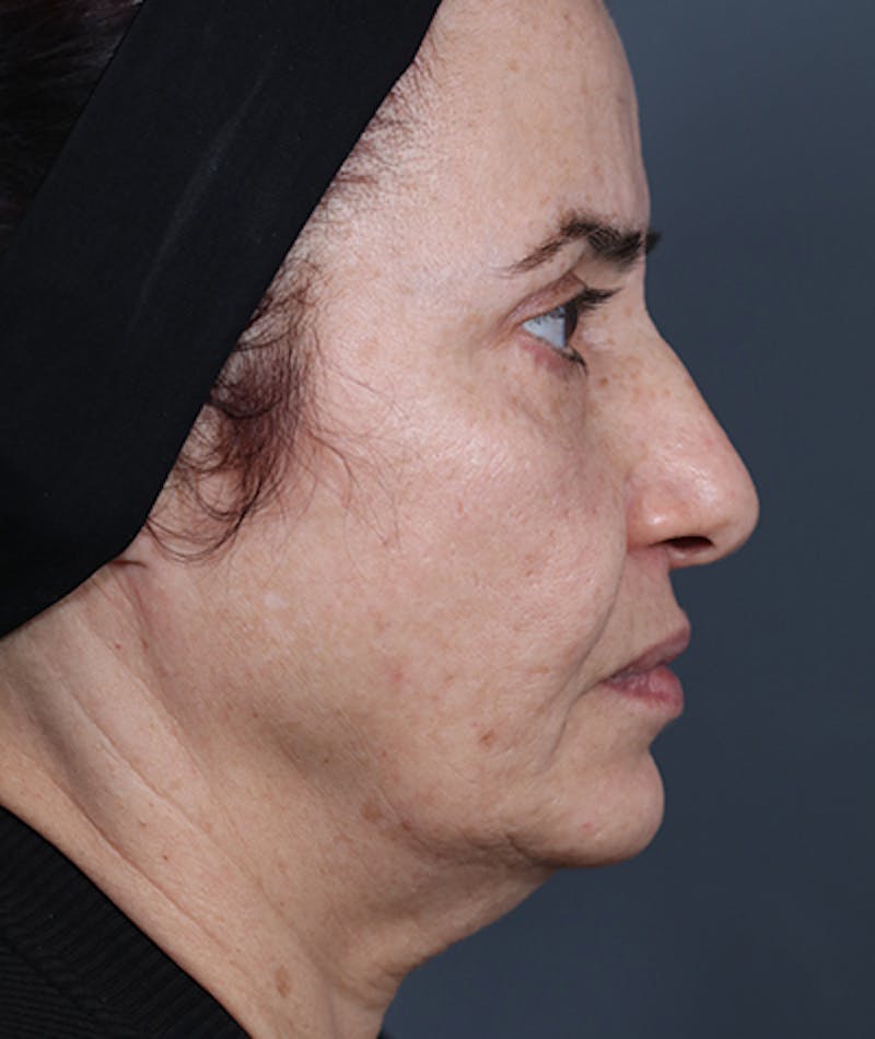 Facelift Before & After Gallery - Patient 108404881 - Image 10