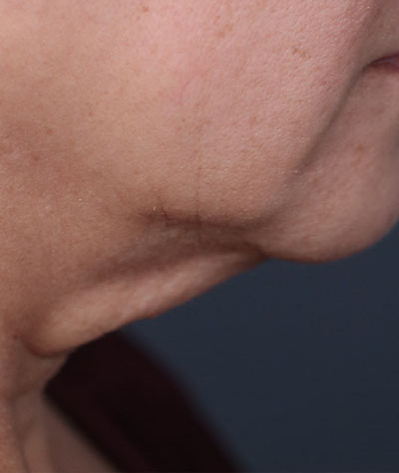 Neck Lift Before & After Gallery - Patient 108420700 - Image 1