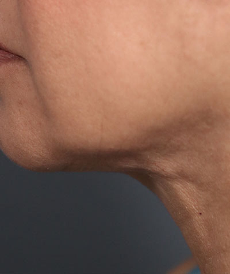 Neck Lift Before & After Gallery - Patient 108420700 - Image 2