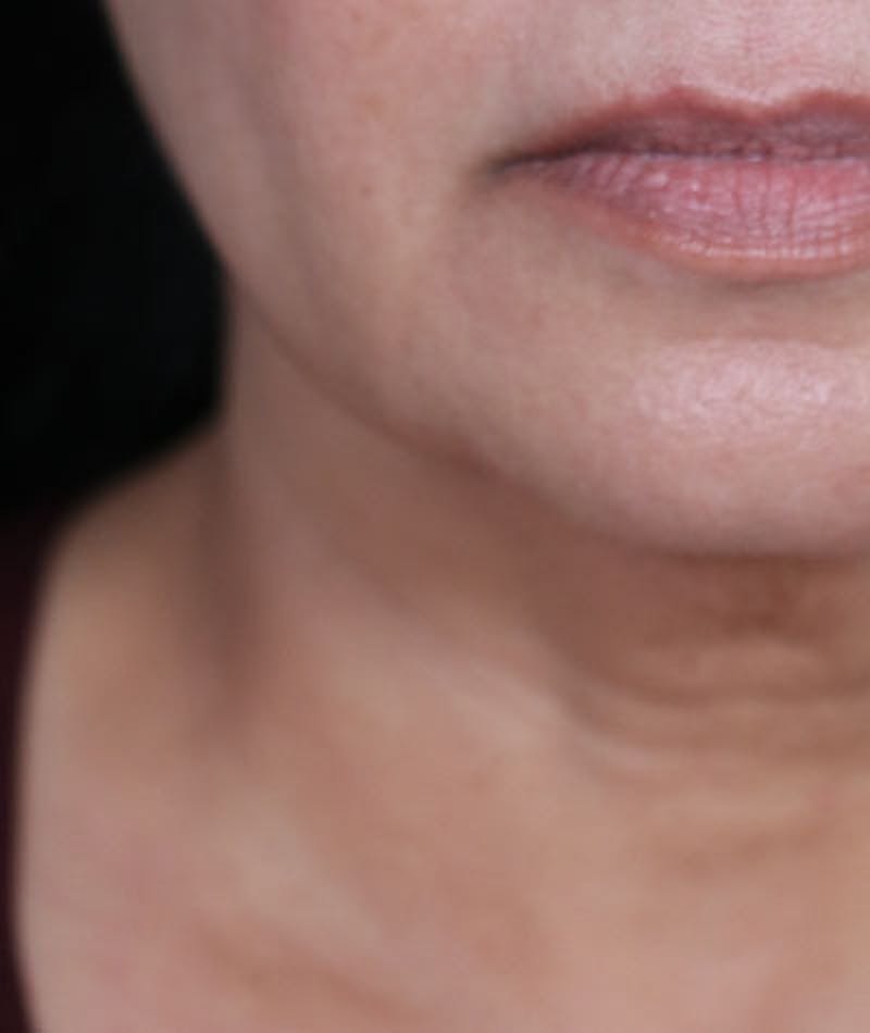 Neck Lift Before & After Gallery - Patient 108420700 - Image 3