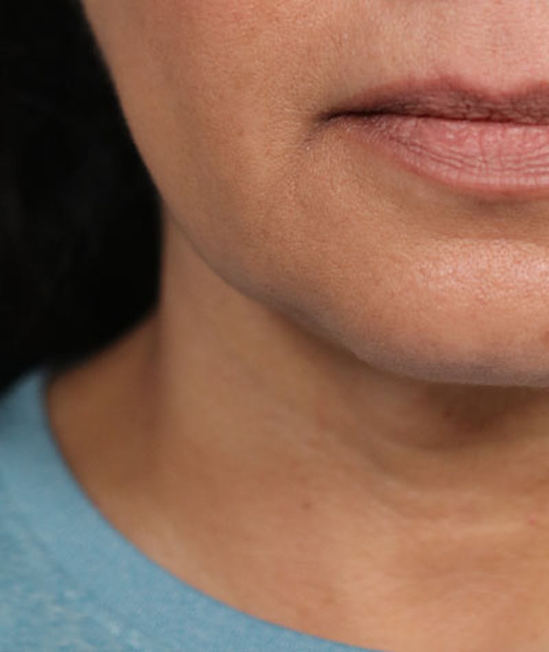 Neck Lift Before & After Gallery - Patient 108420700 - Image 4