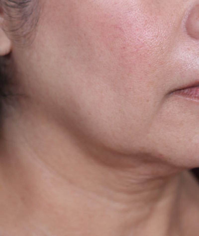 Neck Lift Before & After Gallery - Patient 108420700 - Image 5