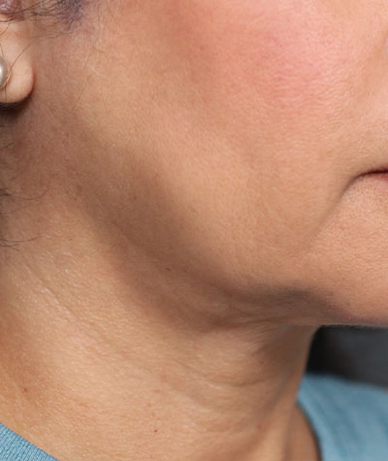 Neck Lift Before & After Gallery - Patient 108420700 - Image 6