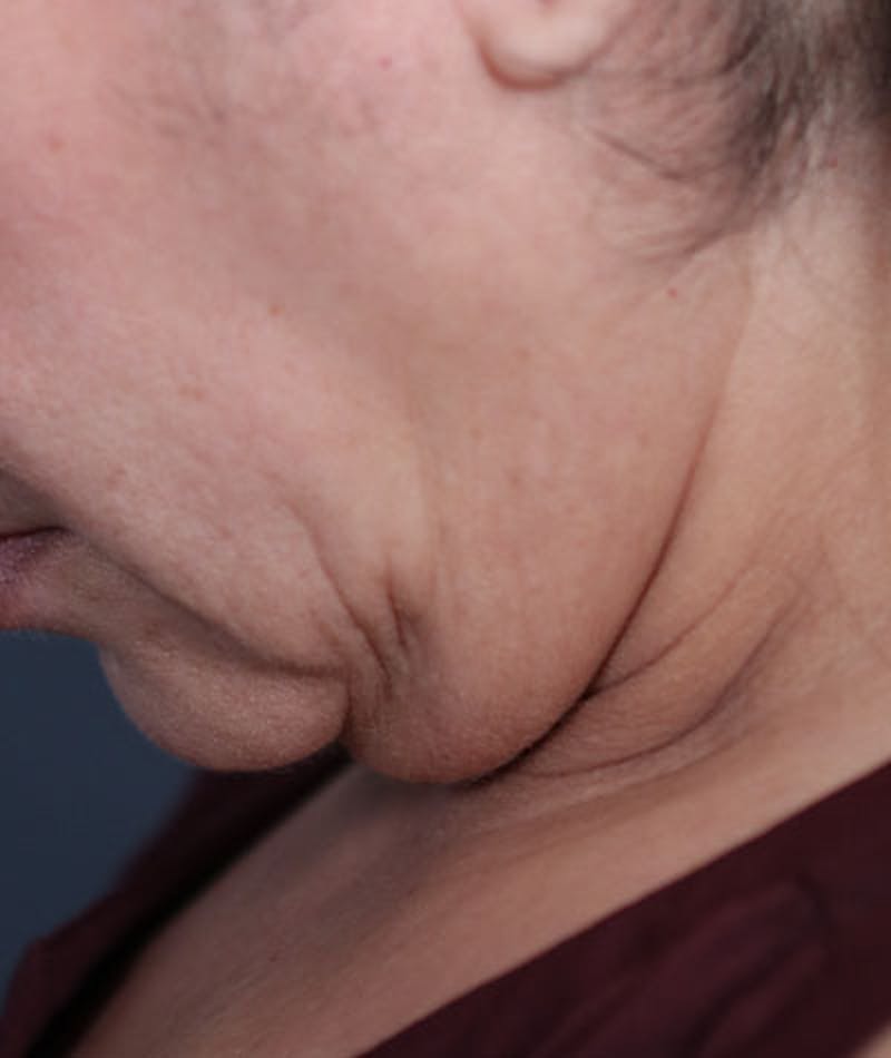 Neck Lift Before & After Gallery - Patient 108420700 - Image 7