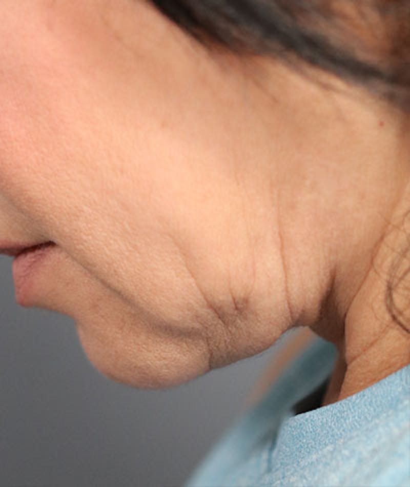 Neck Lift Before & After Gallery - Patient 108420700 - Image 8
