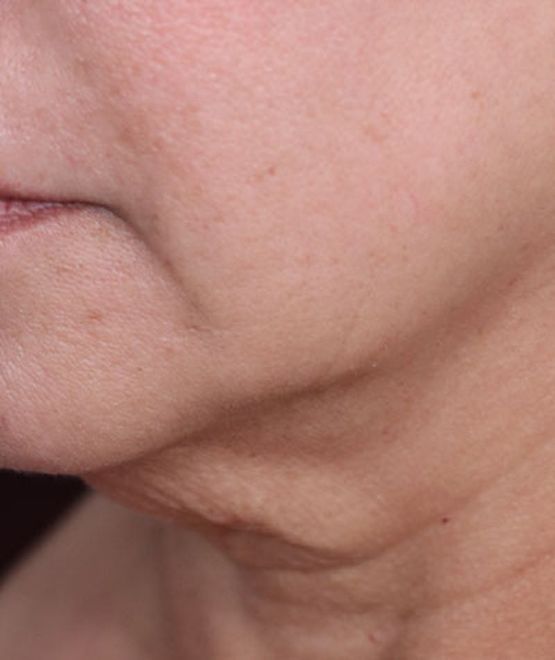 Neck Lift Before & After Gallery - Patient 108420700 - Image 9