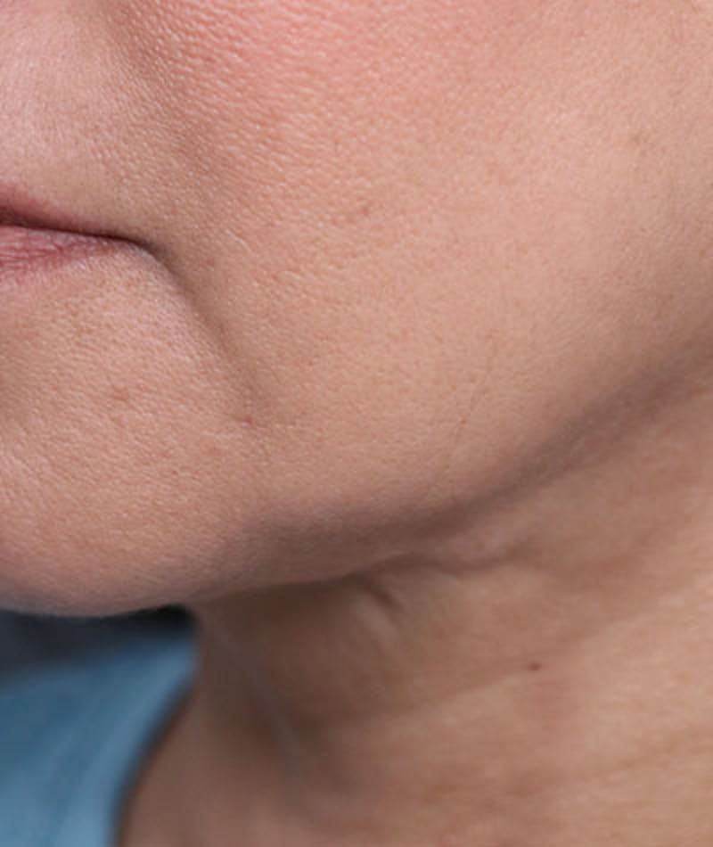 Neck Lift Before & After Gallery - Patient 108420700 - Image 10