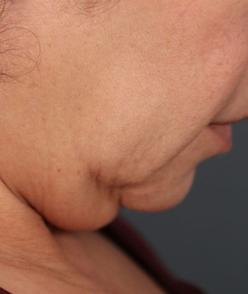 Neck Lift Before & After Gallery - Patient 108420700 - Image 11