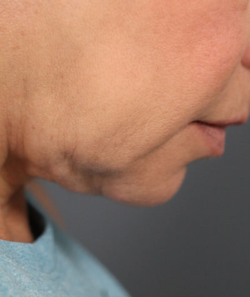 Neck Lift Before & After Gallery - Patient 108420700 - Image 12
