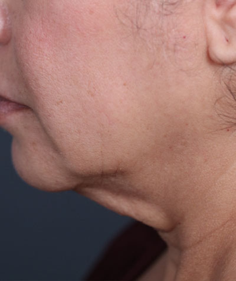 Neck Lift Before & After Gallery - Patient 108420700 - Image 13
